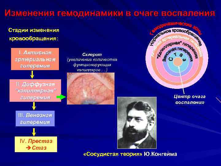 Стадии изменения кровообращения: I. Активная артериальная гиперемия II. Диффузная “капиллярная” гиперемия Склерит (увеличение количества