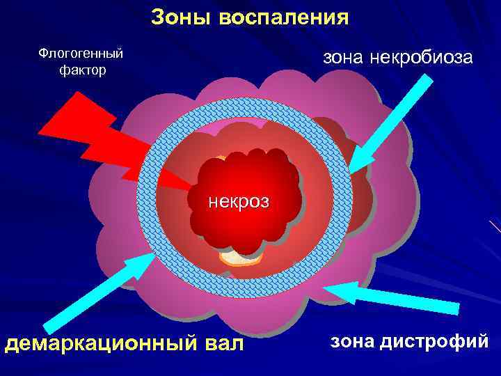 Зоны воспаления Флогогенный фактор зона некробиоза некроз демаркационный вал зона дистрофий 
