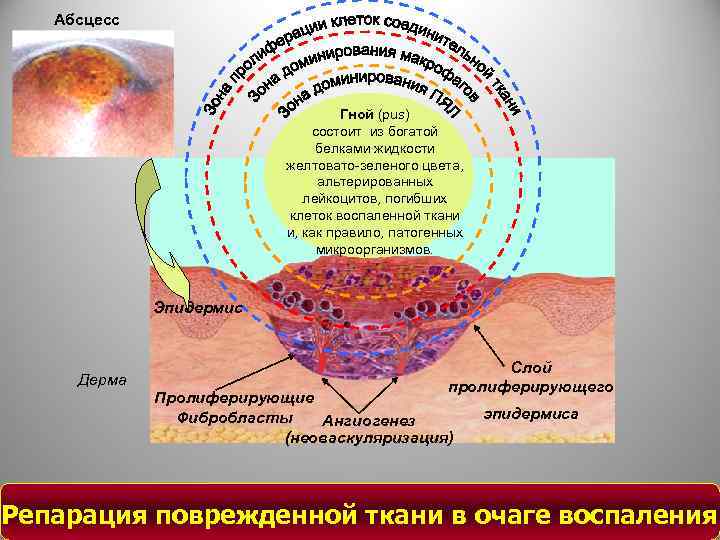 Абсцесс Гной (pus) состоит из богатой белками жидкости желтовато-зеленого цвета, альтерированных лейкоцитов, погибших клеток
