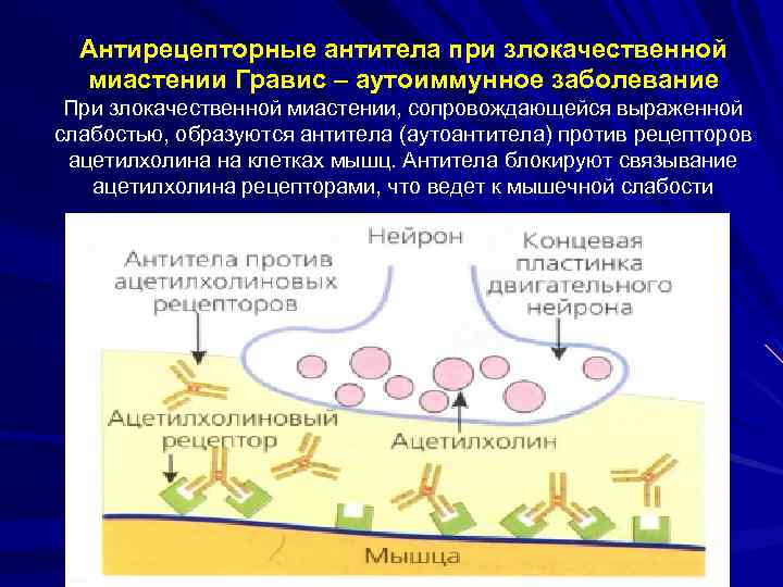 Антирецепторные антитела при злокачественной миастении Гравис – аутоиммунное заболевание При злокачественной миастении, сопровождающейся выраженной