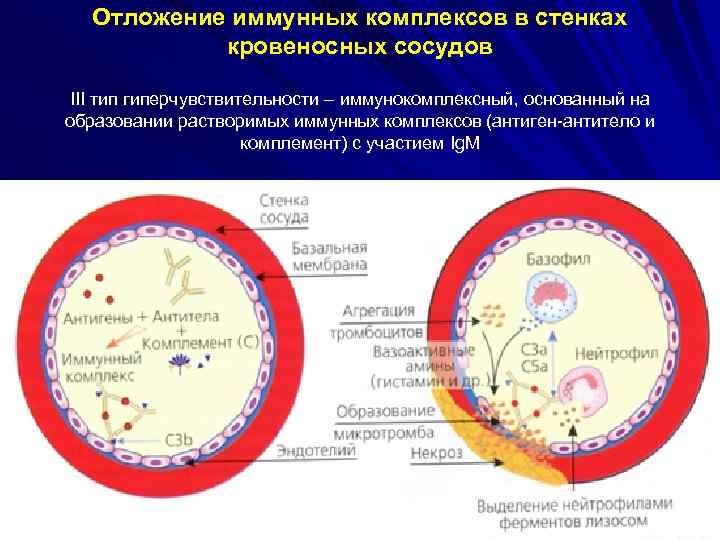 Отложение иммунных комплексов в стенках кровеносных сосудов III тип гиперчувствительности – иммунокомплексный, основанный на