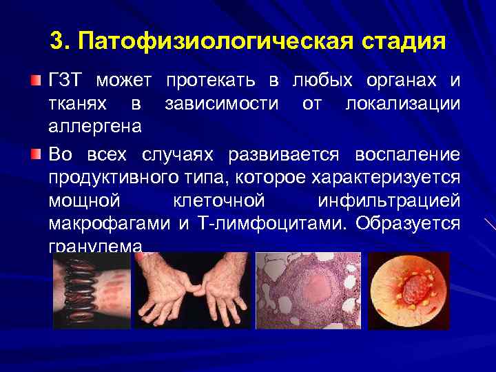 3. Патофизиологическая стадия ГЗТ может протекать в любых органах и тканях в зависимости от