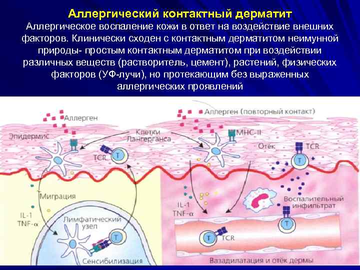 Аллергический контактный дерматит Аллергическое воспаление кожи в ответ на воздействие внешних факторов. Клинически сходен