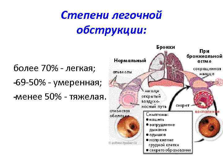 Обструкция легких