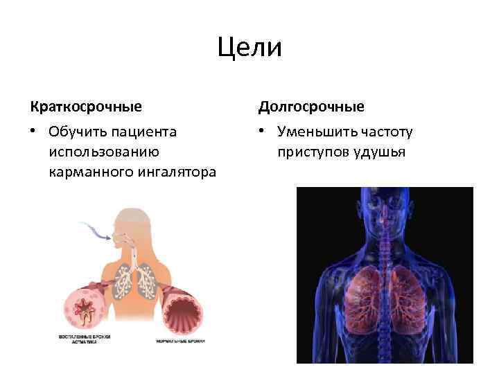 Цели Краткосрочные Долгосрочные • Обучить пациента использованию карманного ингалятора • Уменьшить частоту приступов удушья