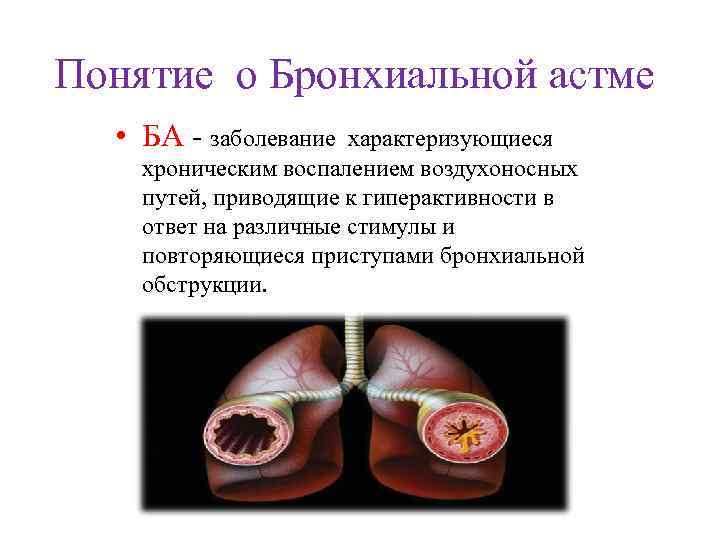 Понятие о Бронхиальной астме • БА - заболевание характеризующиеся хроническим воспалением воздухоносных путей, приводящие