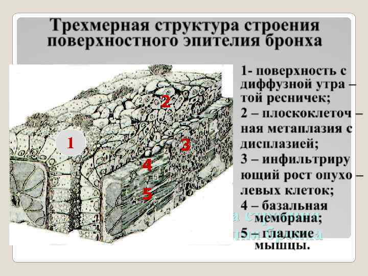 2– плоскоклеточ – ная метаплазия с дисплазией; 2 3 – инфильтриру ющий рост опухо