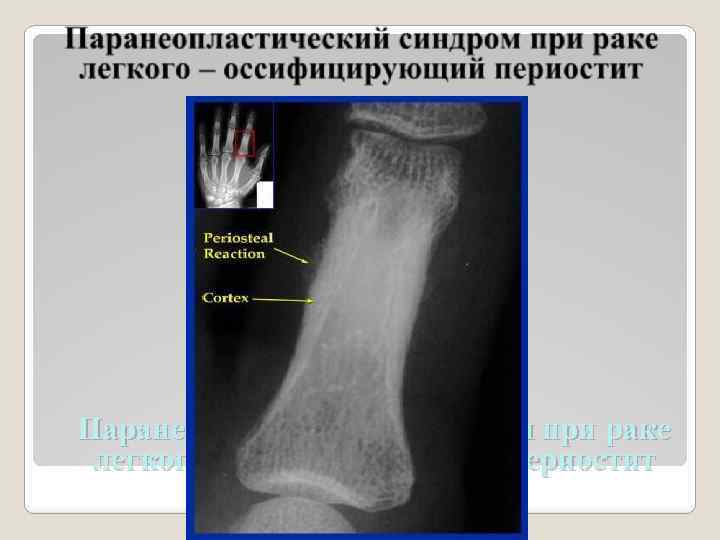 Паранеопластический синдром при раке легкого – оссифицирующий периостит 