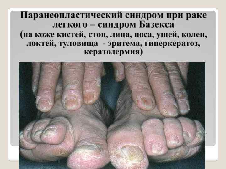 Паранеопластический синдром при раке легкого – синдром Базекса 