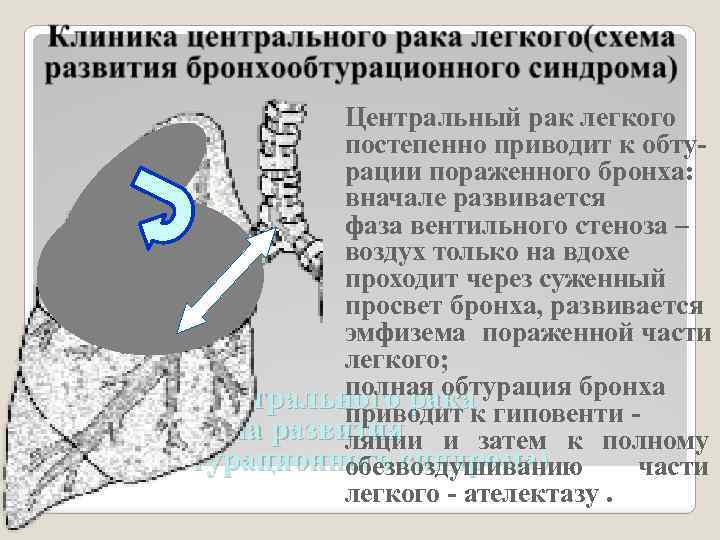 Центральный рак легкого постепенно приводит к обтурации пораженного бронха: вначале развивается фаза вентильного стеноза