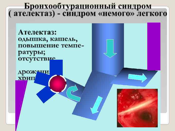 Бронхообтурационный синдром ( ателектаз) - синдром «немого» легкого 