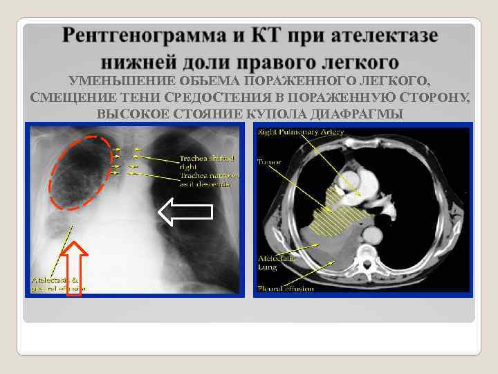 УМЕНЬШЕНИЕ ОБЬЕМА ПОРАЖЕННОГО ЛЕГКОГО, СМЕЩЕНИЕ ТЕНИ СРЕДОСТЕНИЯ В ПОРАЖЕННУЮ СТОРОНУ, ВЫСОКОЕ СТОЯНИЕ КУПОЛА ДИАФРАГМЫ