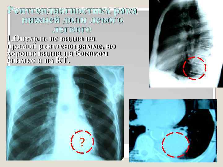 Рентгендиагностика рака нижней доли левого легкого 1. Опухoль не видна на прямой рентгенограмме, но