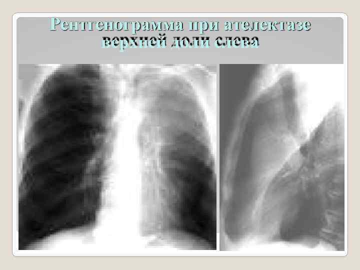 Рентгенограмма при ателектазе верхней доли слева 