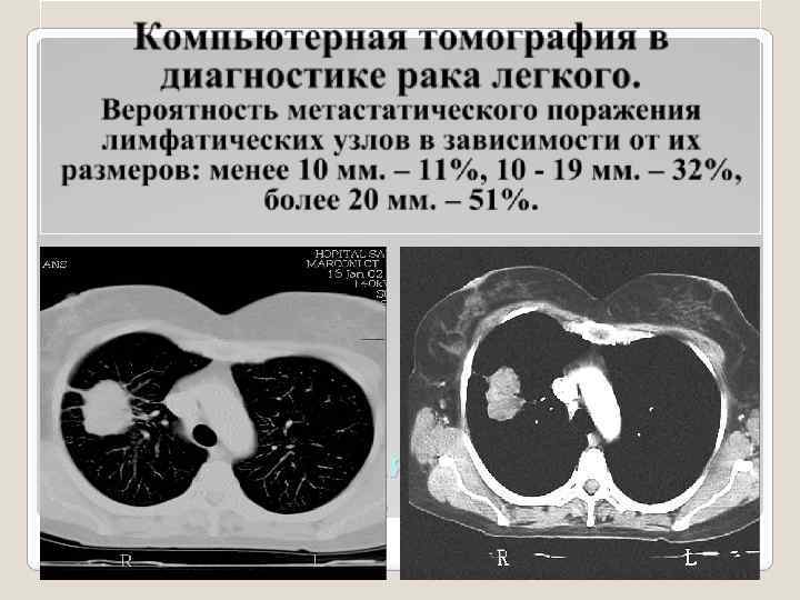 Компьютерная томография в диагностике рака легкого. 