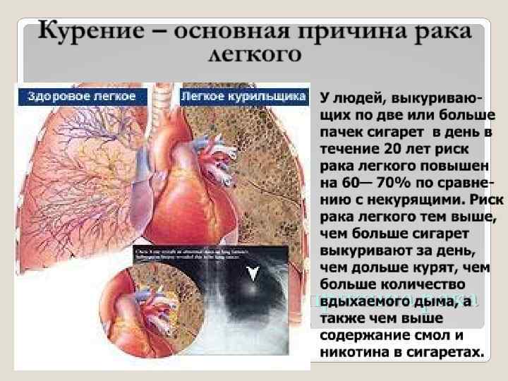 Курение – основная причина рака легкого 