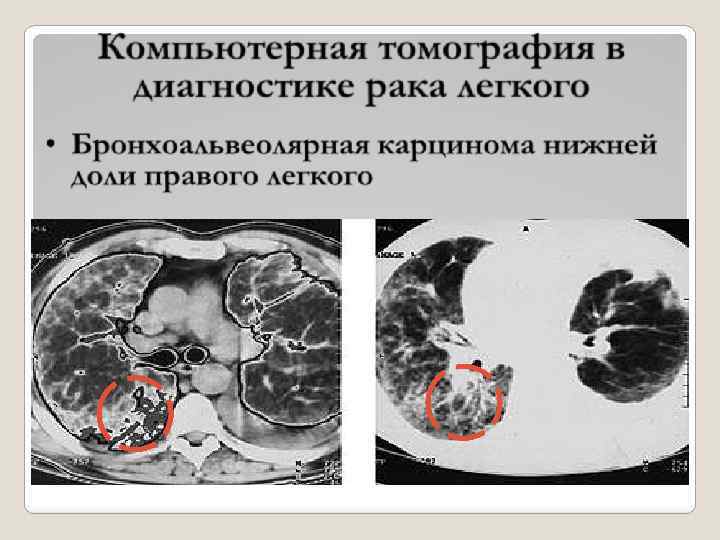 Компьютерная томография в диагностике рака легкого 