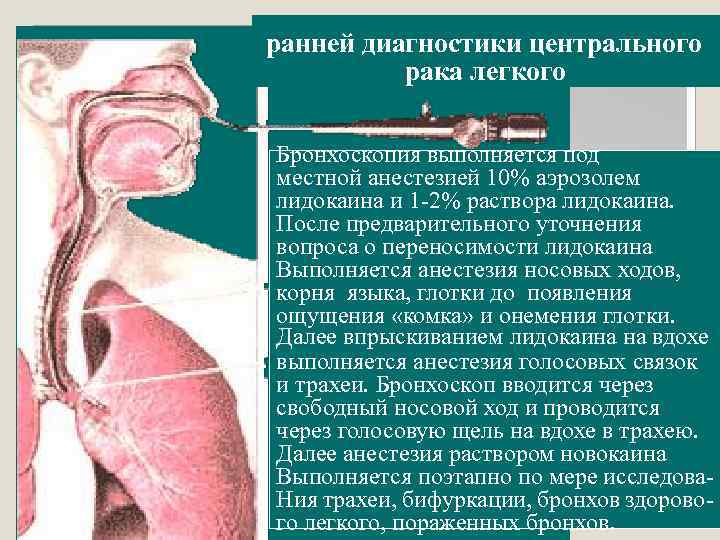 ранней диагностики центрального рака легкого • Докторna. by Бронхоскопия выполняется под местной анестезией 10%