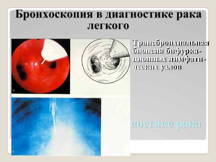 Трансбронхиальная биопсия бифуркационных лимфатических узлов Бронхоскопия в диагностике рака легкого 