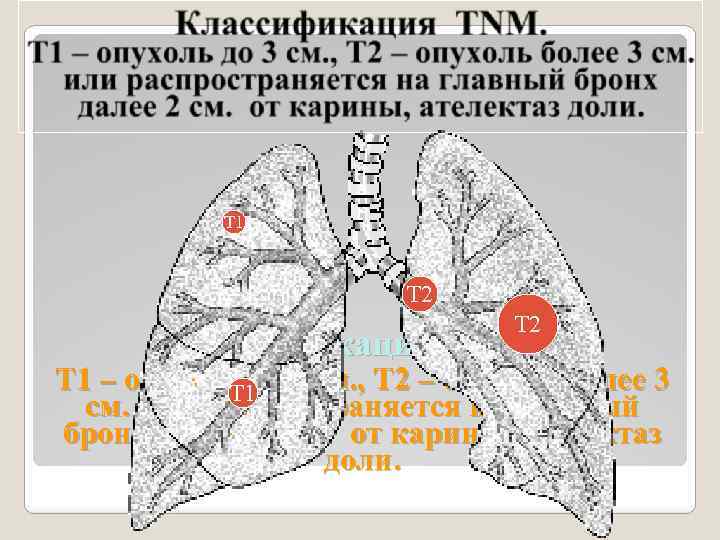 Т 1 Т 2 Классификация TNM. Т 1 – опухоль до 3 см. ,