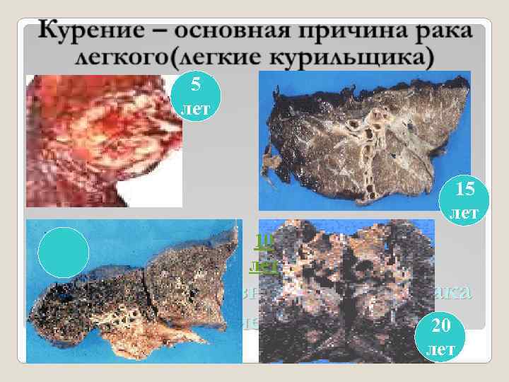 5 лет 10 лет Курение – основная причина рака легкого(легкие курильщика)20 лет 