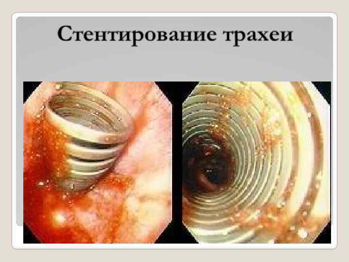Стентирование трахеи 