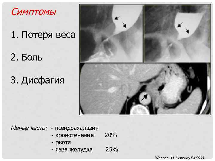 Симптомы 1. Потеря веса 2. Боль 3. Дисфагия Менее часто: - псевдоахалазия - кровотечение