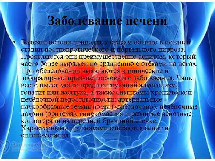 Заболевание печени • Болезни печени приводят к отёкам обычно в поздней стадии постнекротического и