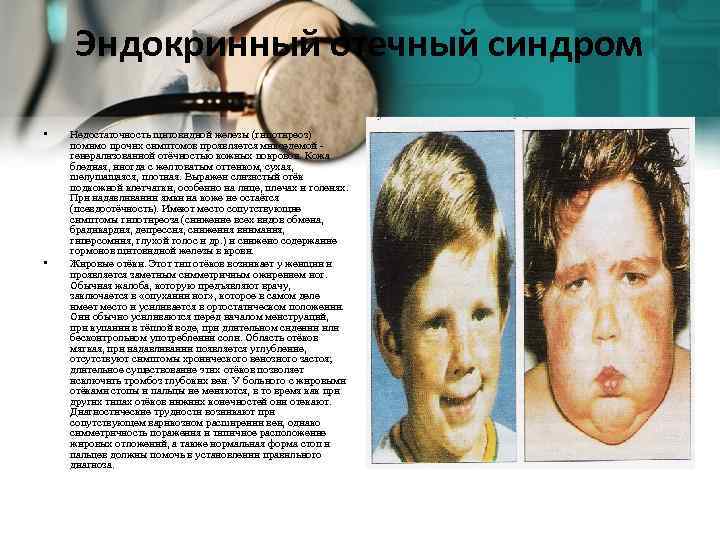 Эндокринный отечный синдром • • Недостаточность щитовидной железы (гипотиреоз) помимо прочих симптомов проявляется микседемой