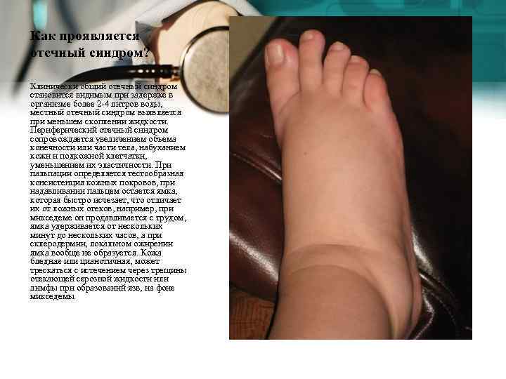 Как проявляется отечный синдром? Клинически общий отечный синдром становится видимым при задержке в организме