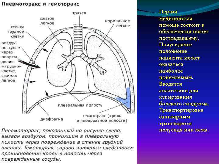 Первая медицинская помощь состоит в обеспечении покоя пострадавшему. Полусидячее положение пациента может оказаться наиболее