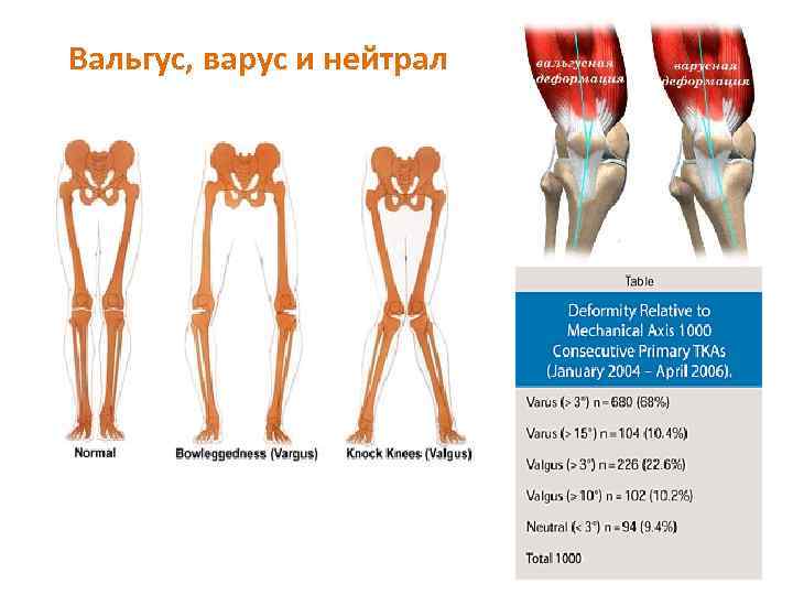 Вальгус и варус фото