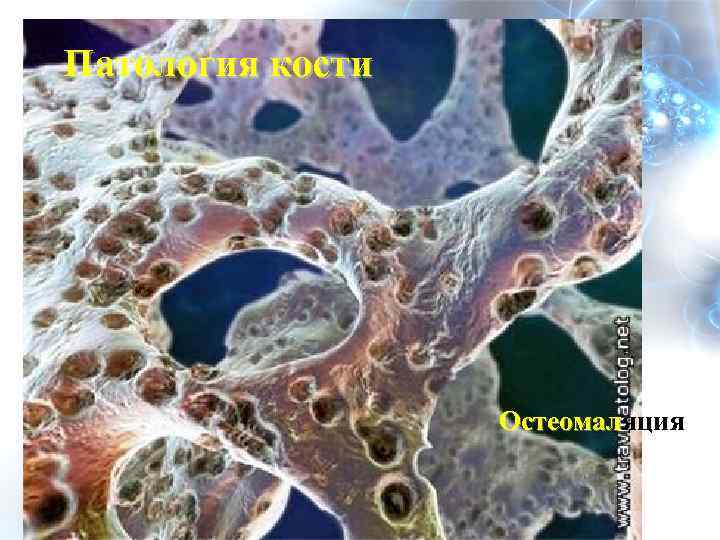 Патология кости Остеомаляция 