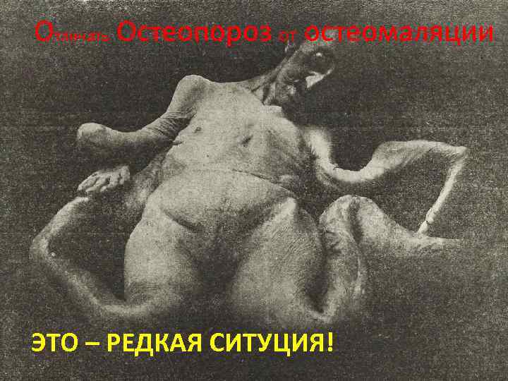 Отличать Остеопороз от остеомаляции ЭТО – РЕДКАЯ СИТУЦИЯ! 
