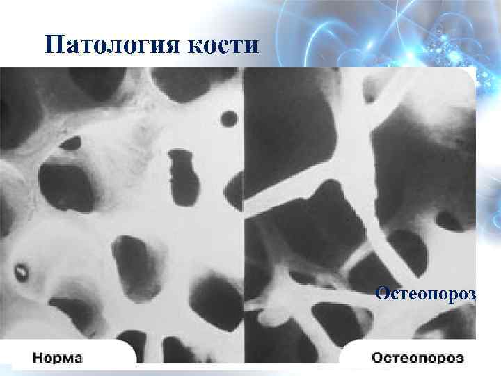 Патология кости Остеопороз 