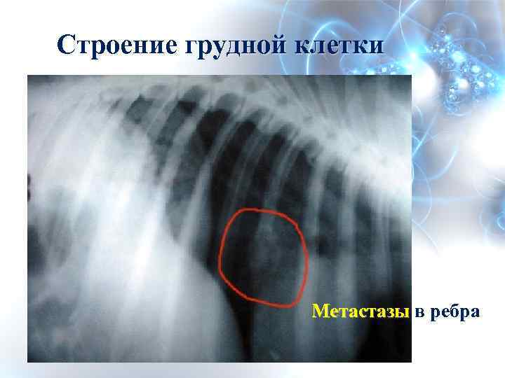 Кава дагли гомель. Остеосаркома ребра на рентгене. Хондросаркома ребра рентген. Метастазы в ребрах рентген. Остеосаркома грудной клетки рентген.