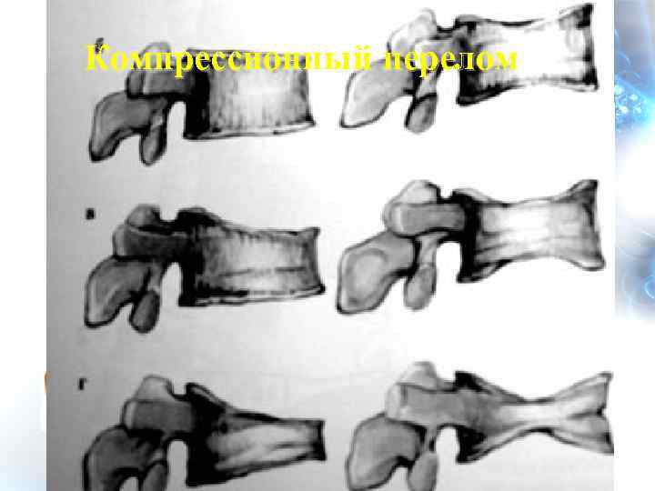 Компрессионный перелом 