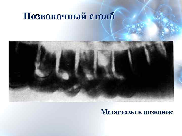 Позвоночный столб Метастазы в позвонок 