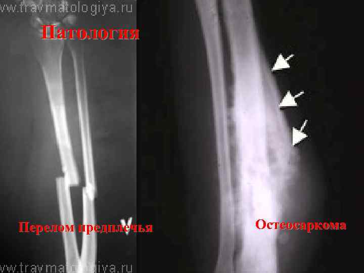 Патология Перелом предплечья Остеосаркома 