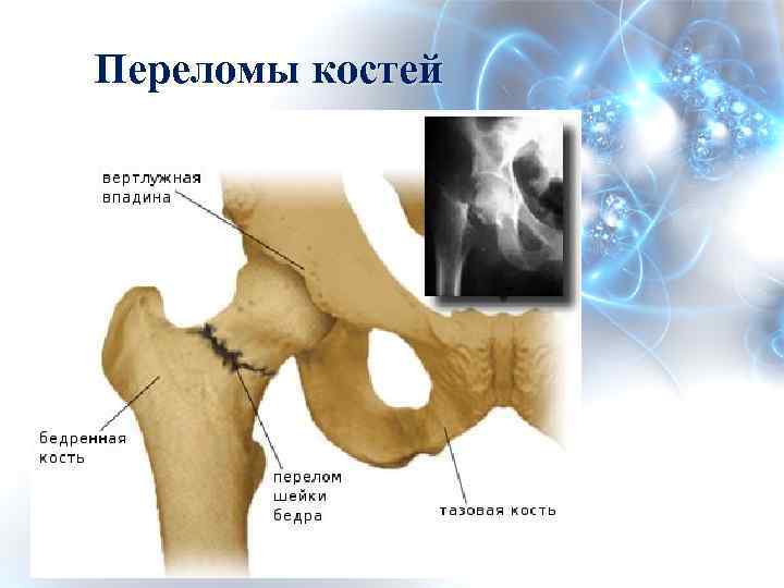 Переломы костей 