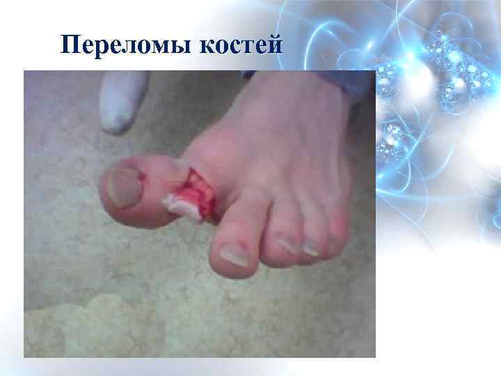 Переломы костей 