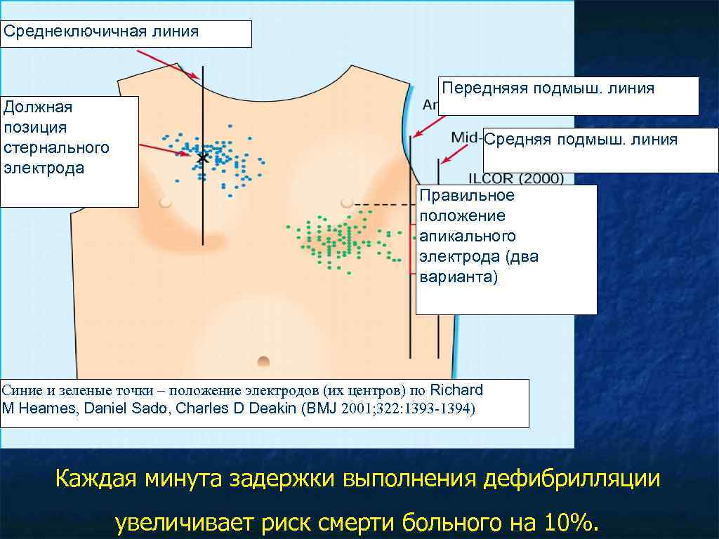 Среднеключичная линия Передняяя подмыш. линия Должная позиция стернального электрода Средняя подмыш. линия Правильное положение