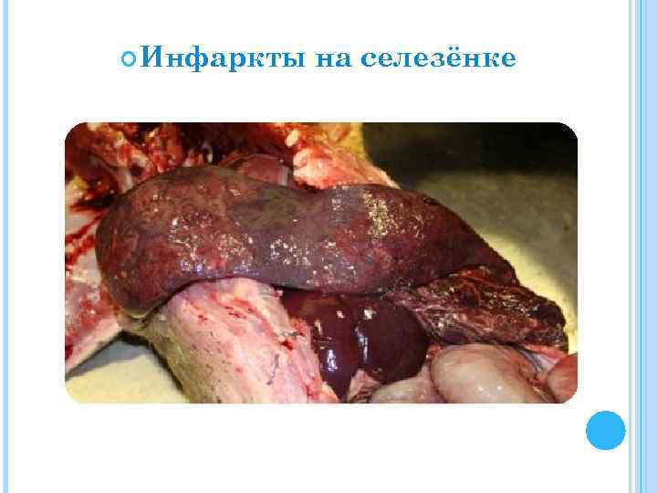  Инфаркты на селезёнке 