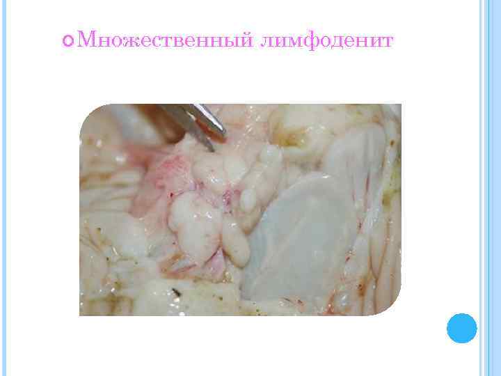  Множественный лимфоденит 