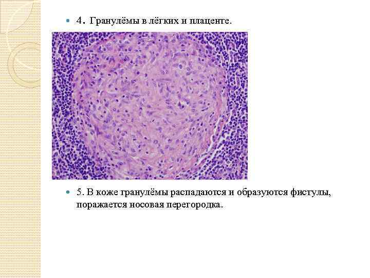 . 4 Гранулёмы в лёгких и плаценте. 5. В коже гранулёмы распадаются и образуются