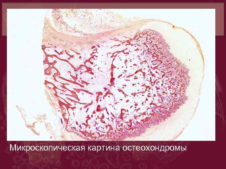 Микроскопическая картина остеохондромы 
