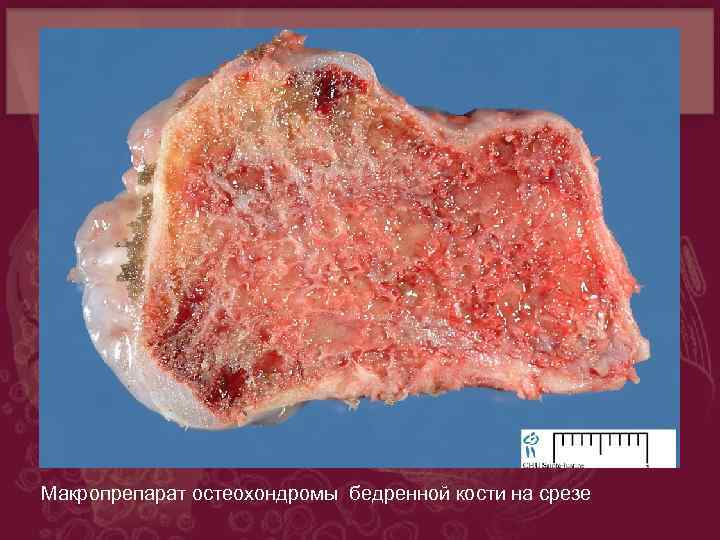 Доброкачественная опухоль молочной железы у женщин фото