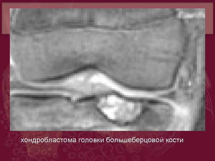 хондробластома головки большеберцовой кости 