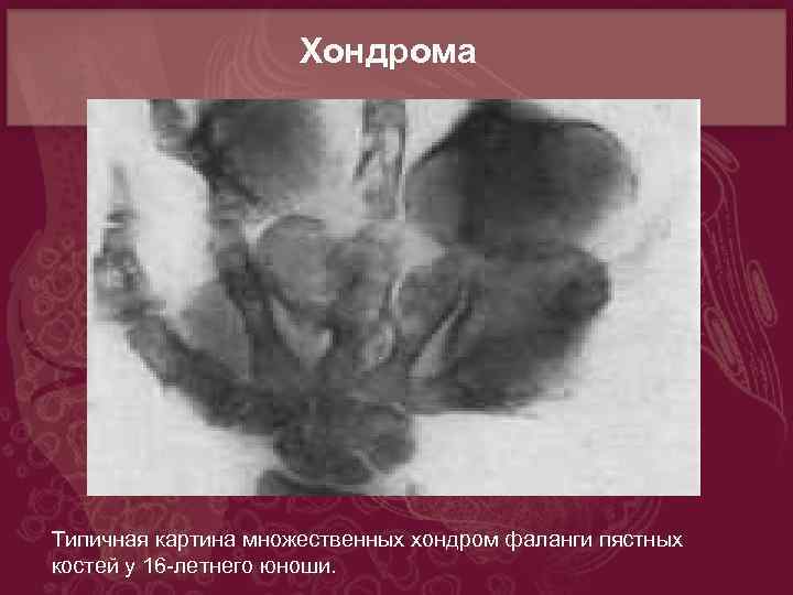 Мр картина множественных супратенториальных очагов глиоза