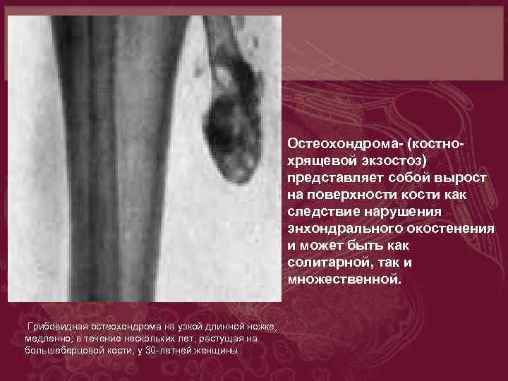 Первичные злокачественные опухоли костей особенности рентгеновской картины